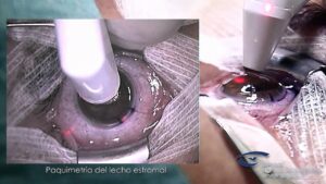 Correccion-visual-gafas-lentes-de-contacto-cirugia-refractiva