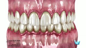 Enfermedades-dentales-comunes-caries-gingivitis-periodontitis