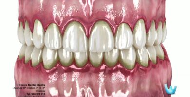 Enfermedades dentales comunes caries gingivitis periodontitis
