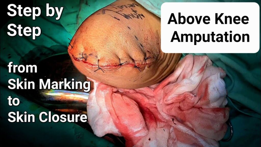 Amputacion femoral