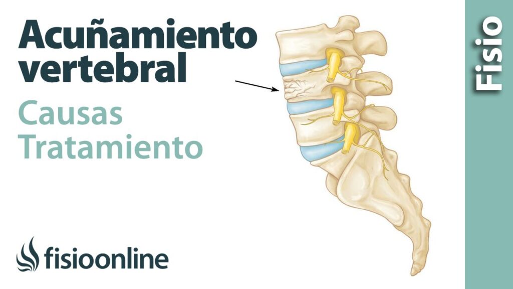 Aplastamiento acunamiento vertebral