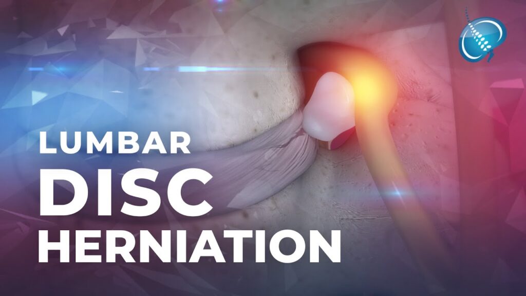 Hernia discal lumbar