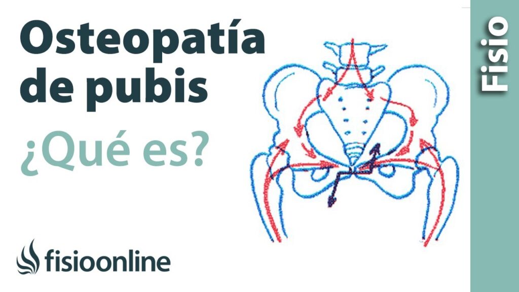 Osteopatia de pubis Pubalgia